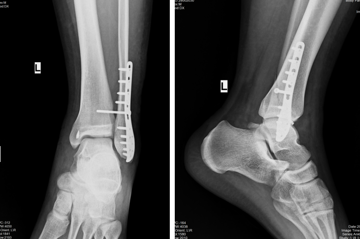 踝关节下胫腓联合损伤的诊治