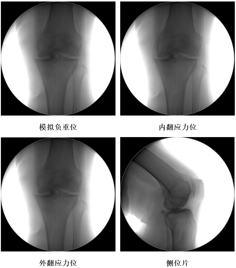 【手术视频】双侧固定平台单髁置换术