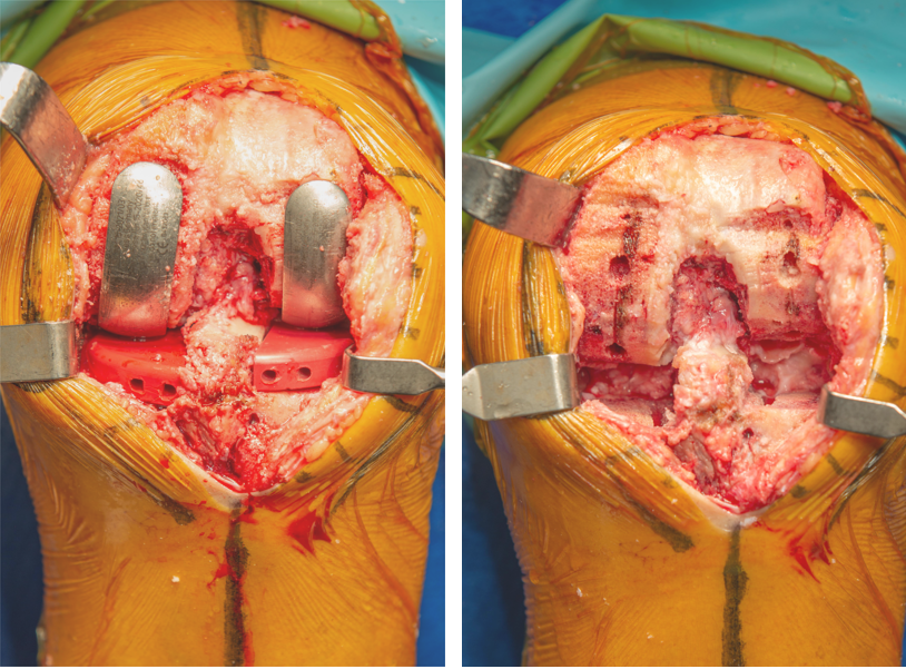 【手术视频】双侧固定平台单髁置换术