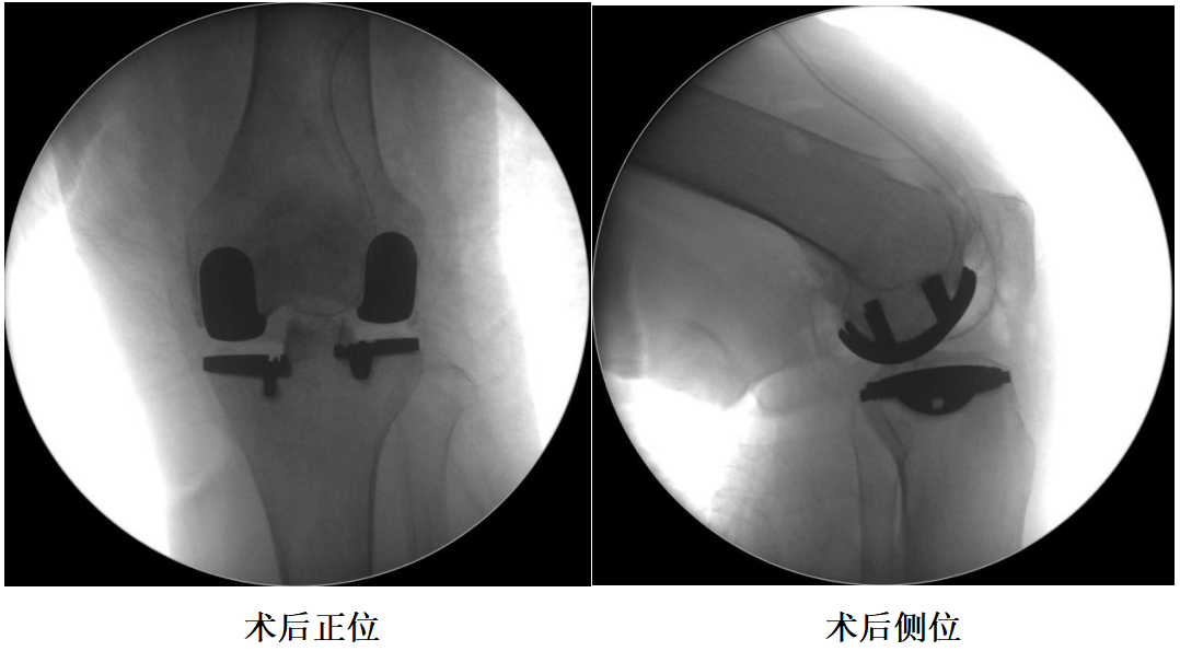 【手术视频】双侧固定平台单髁置换术