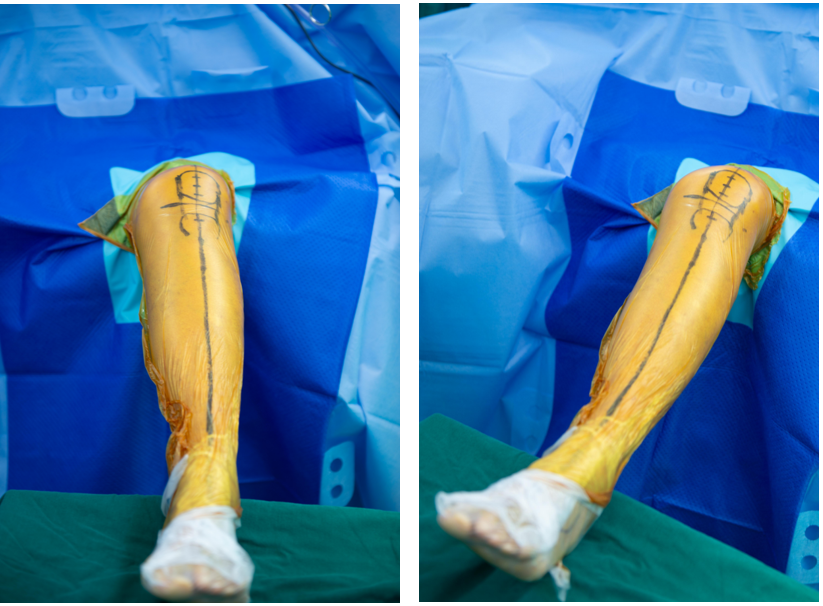 【手术视频】双侧固定平台单髁置换术