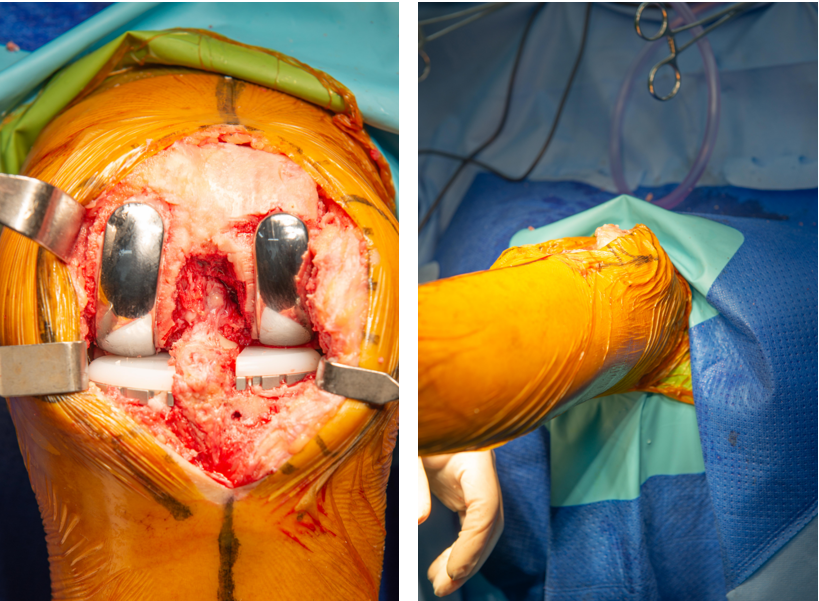 【手术视频】双侧固定平台单髁置换术