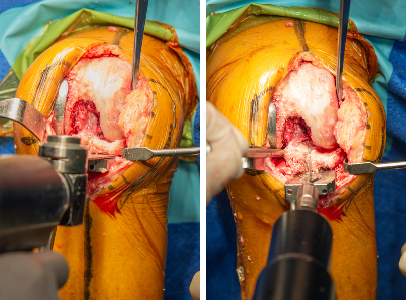 【手术视频】双侧固定平台单髁置换术