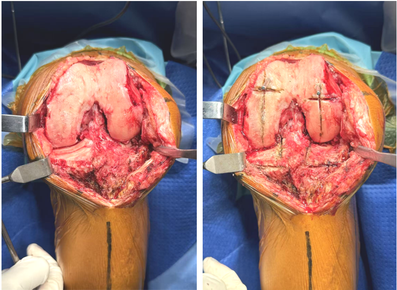 【手术视频】双侧固定平台单髁置换术