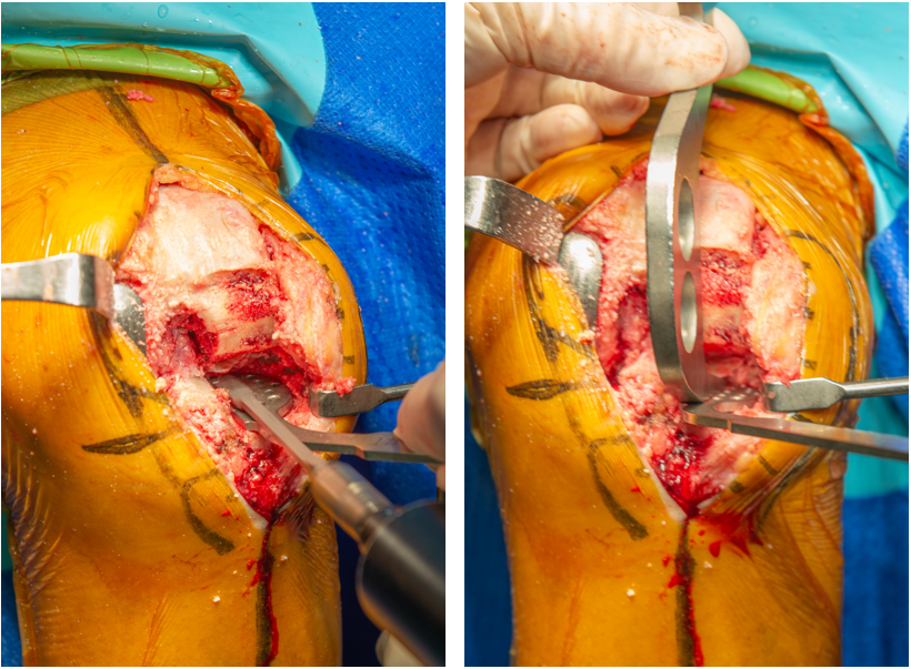 【手术视频】双侧固定平台单髁置换术