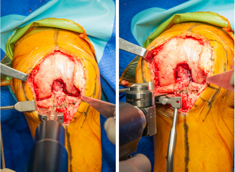 【手术视频】双侧固定平台单髁置换术