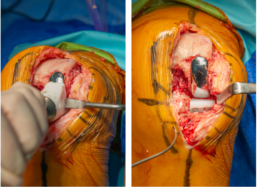 【手术视频】双侧固定平台单髁置换术