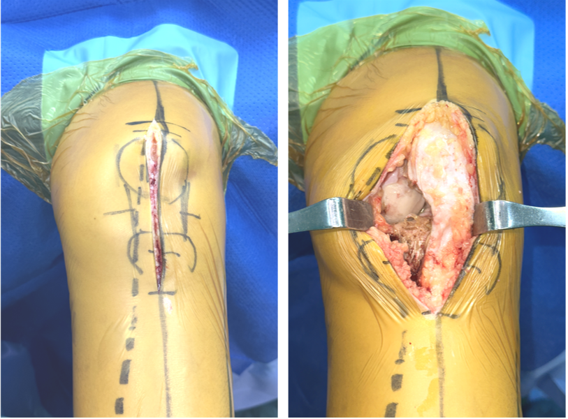 【手术视频】双侧固定平台单髁置换术