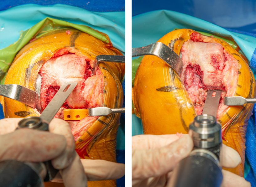 【手术视频】双侧固定平台单髁置换术