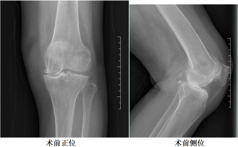 【手术视频】双侧固定平台单髁置换术