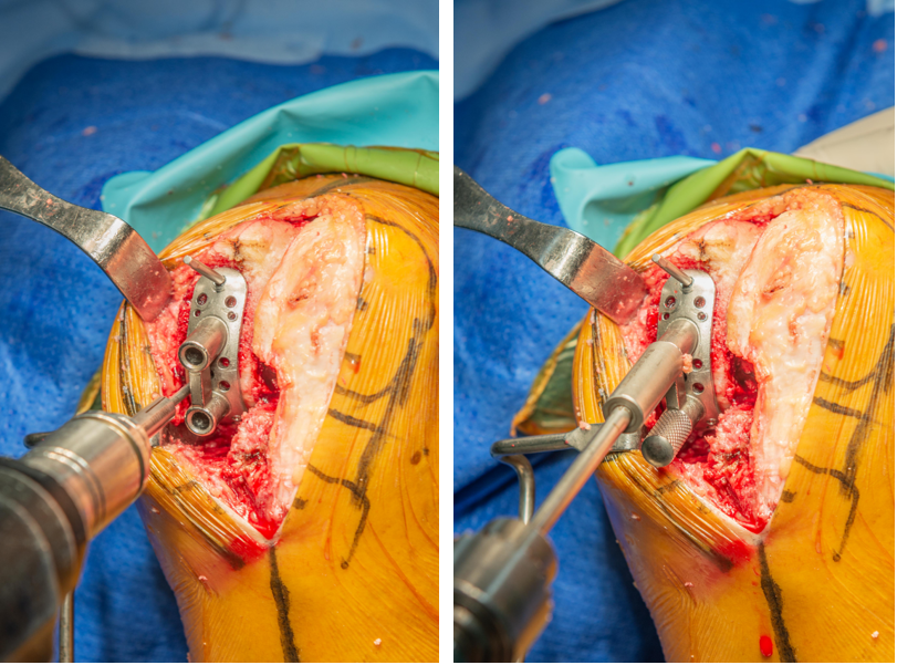 【手术视频】双侧固定平台单髁置换术