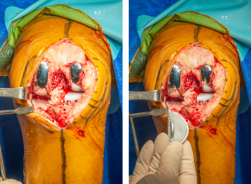 【手术视频】双侧固定平台单髁置换术