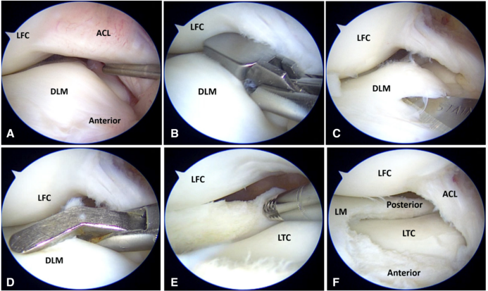 全面掌握盘状半月板的概念及损伤后该如何处理