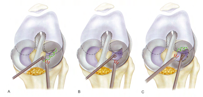 全面掌握盘状半月板的概念及损伤后该如何处理