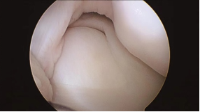 全面掌握盘状半月板的概念及损伤后该如何处理