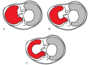全面掌握盘状半月板的概念及损伤后该如何处理