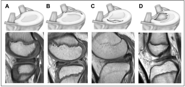 全面掌握盘状半月板的概念及损伤后该如何处理