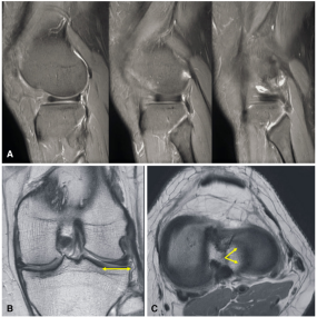 全面掌握盘状半月板的概念及损伤后该如何处理