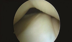 全面掌握盘状半月板的概念及损伤后该如何处理