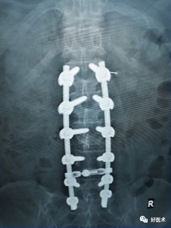 快准稳置入腰椎椎弓根螺钉，这些方法技巧你都掌握了吗？