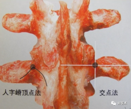 快准稳置入腰椎椎弓根螺钉，这些方法技巧你都掌握了吗？