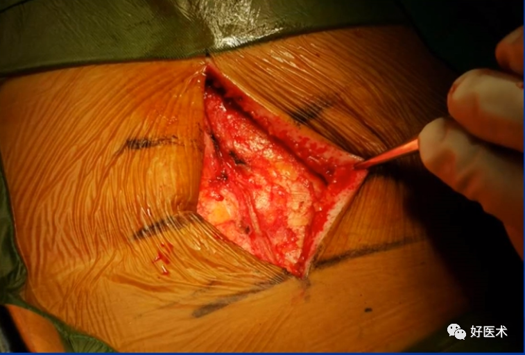 快准稳置入腰椎椎弓根螺钉，这些方法技巧你都掌握了吗？