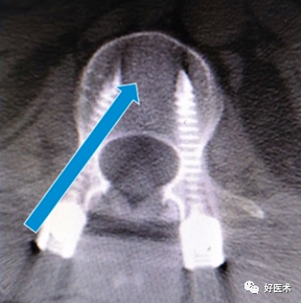 快准稳置入腰椎椎弓根螺钉，这些方法技巧你都掌握了吗？
