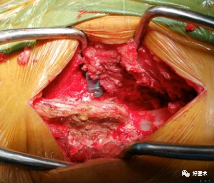 快准稳置入腰椎椎弓根螺钉，这些方法技巧你都掌握了吗？