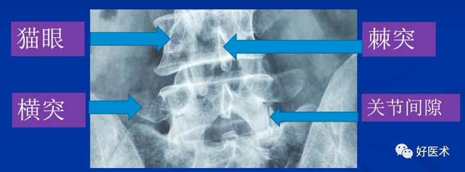 快准稳置入腰椎椎弓根螺钉，这些方法技巧你都掌握了吗？