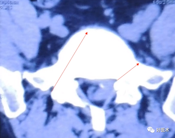 快准稳置入腰椎椎弓根螺钉，这些方法技巧你都掌握了吗？