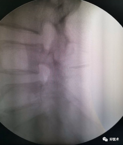 快准稳置入腰椎椎弓根螺钉，这些方法技巧你都掌握了吗？