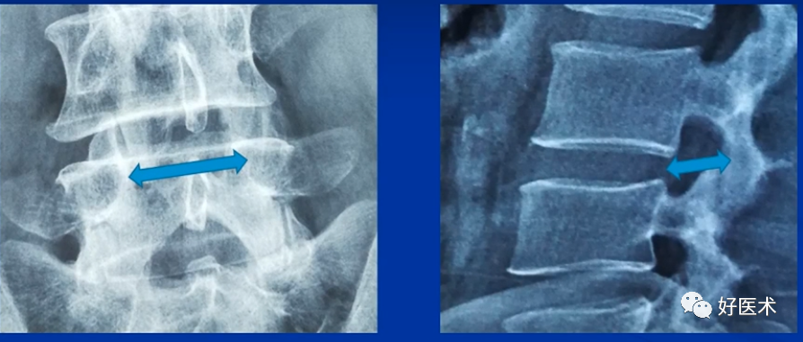 快准稳置入腰椎椎弓根螺钉，这些方法技巧你都掌握了吗？