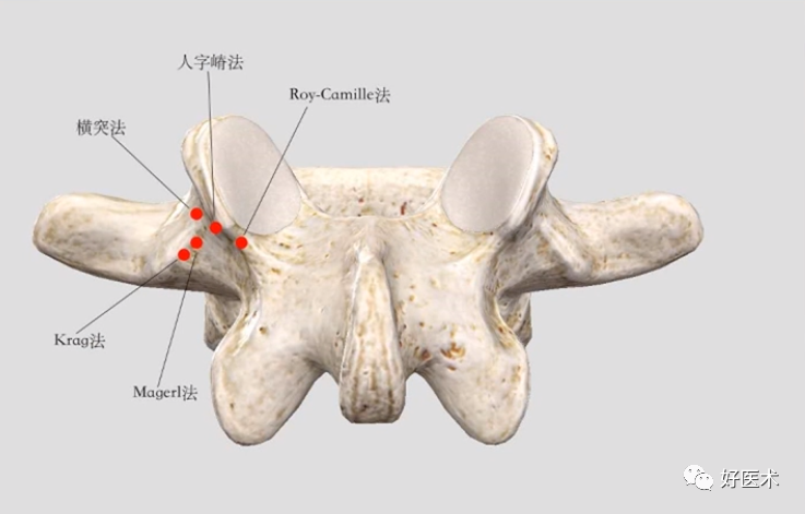 快准稳置入腰椎椎弓根螺钉，这些方法技巧你都掌握了吗？