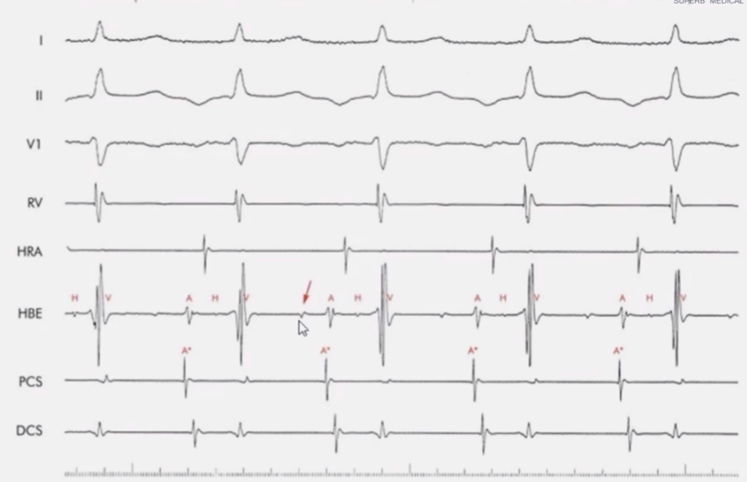 心律解码丨室上性心动过速诊断与治疗，一文详解！