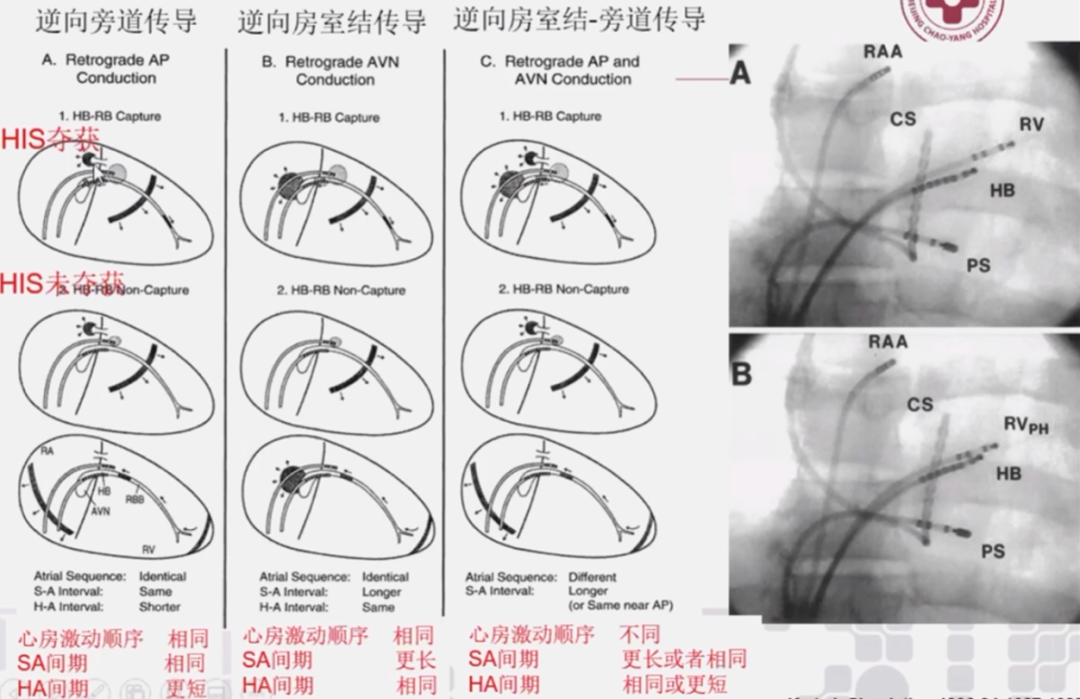 心律解码丨室上性心动过速诊断与治疗，一文详解！