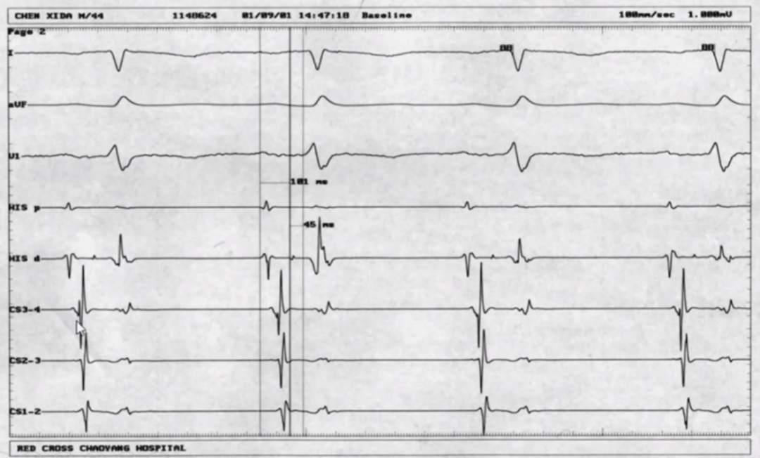 心律解码丨室上性心动过速诊断与治疗，一文详解！