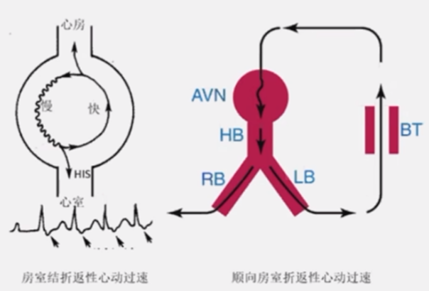 心律解码丨室上性心动过速诊断与治疗，一文详解！