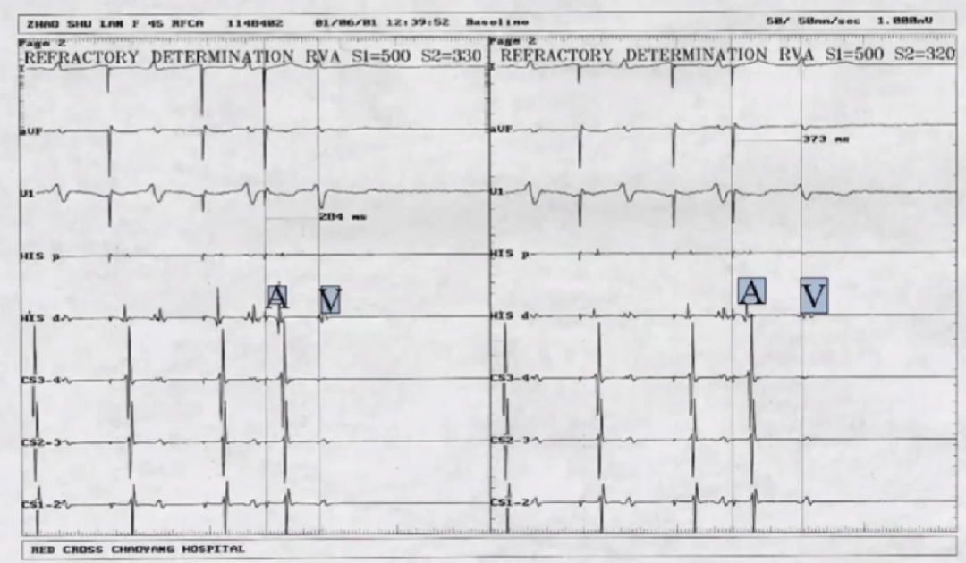 心律解码丨室上性心动过速诊断与治疗，一文详解！