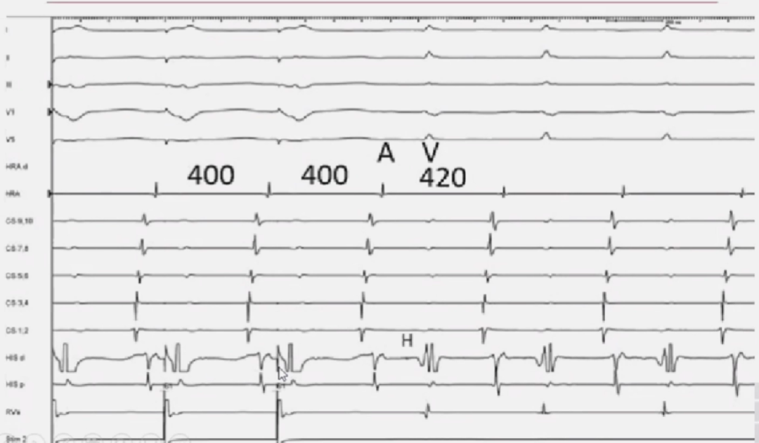 心律解码丨室上性心动过速诊断与治疗，一文详解！