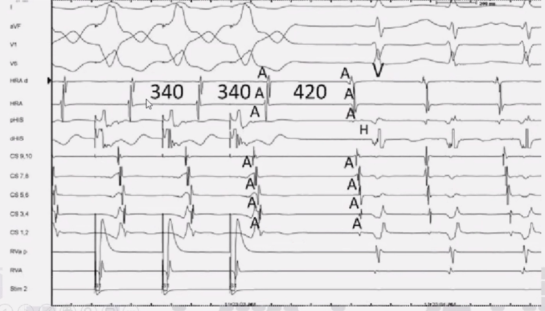 心律解码丨室上性心动过速诊断与治疗，一文详解！