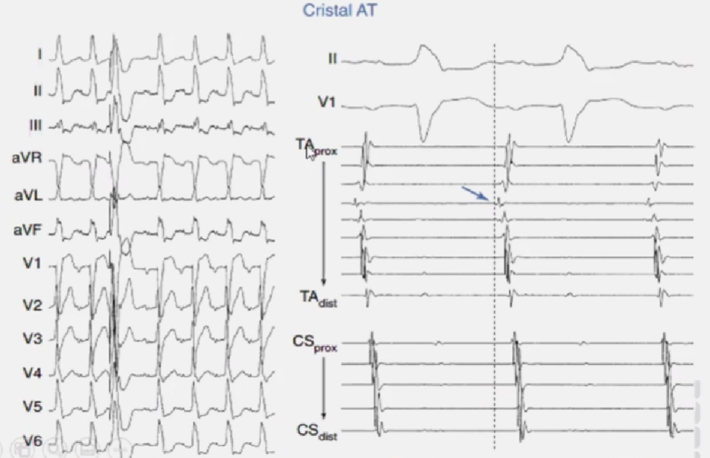 心律解码丨室上性心动过速诊断与治疗，一文详解！