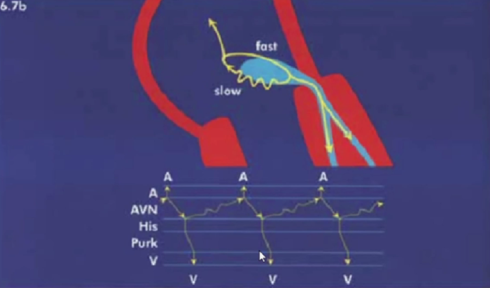心律解码丨室上性心动过速诊断与治疗，一文详解！