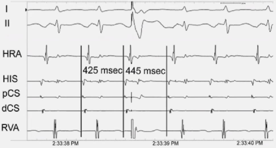 心律解码丨室上性心动过速诊断与治疗，一文详解！