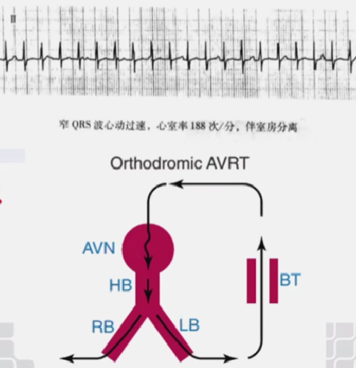心律解码丨室上性心动过速诊断与治疗，一文详解！
