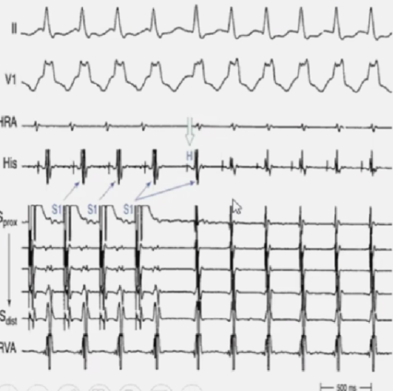 心律解码丨室上性心动过速诊断与治疗，一文详解！