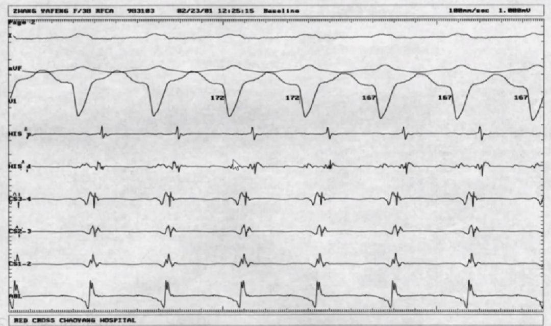 心律解码丨室上性心动过速诊断与治疗，一文详解！