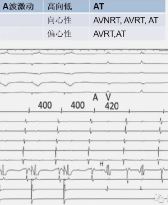 心律解码丨室上性心动过速诊断与治疗，一文详解！