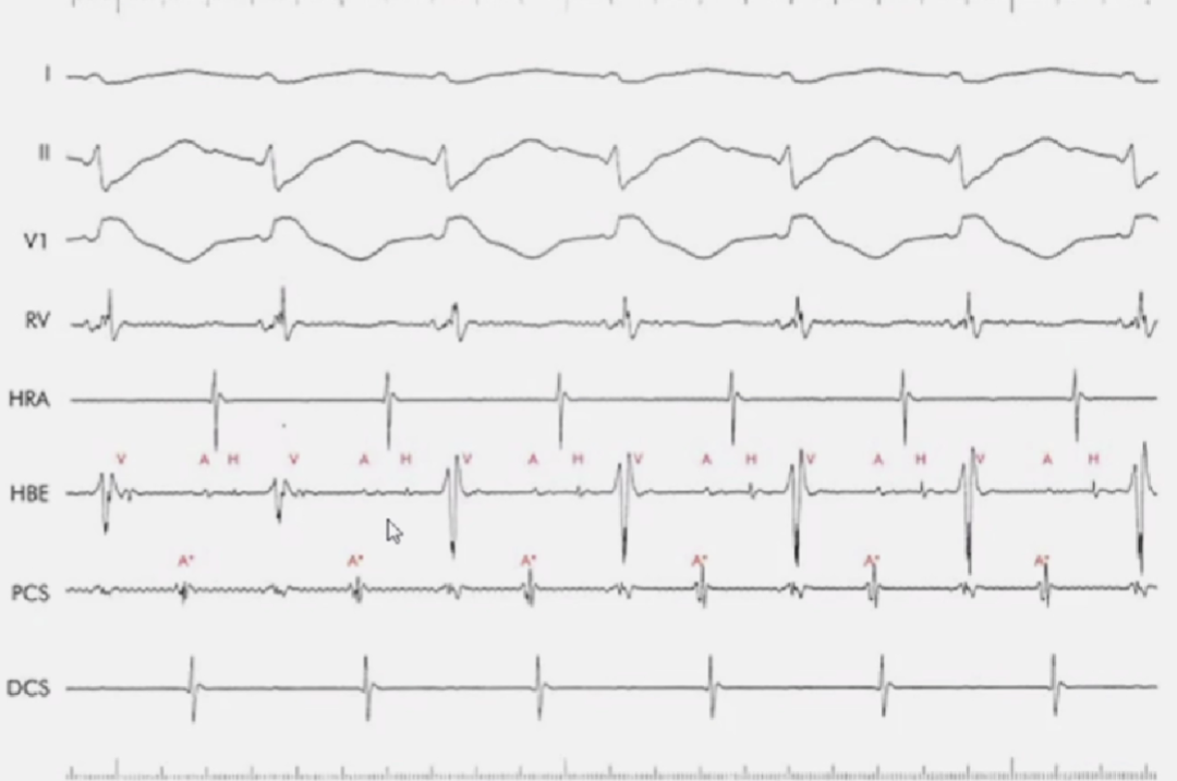 心律解码丨室上性心动过速诊断与治疗，一文详解！