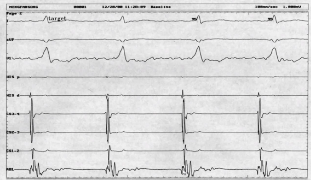 心律解码丨室上性心动过速诊断与治疗，一文详解！