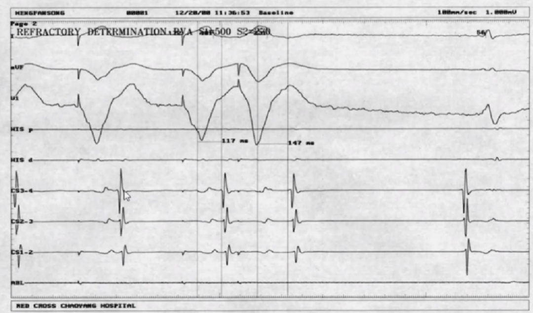 心律解码丨室上性心动过速诊断与治疗，一文详解！